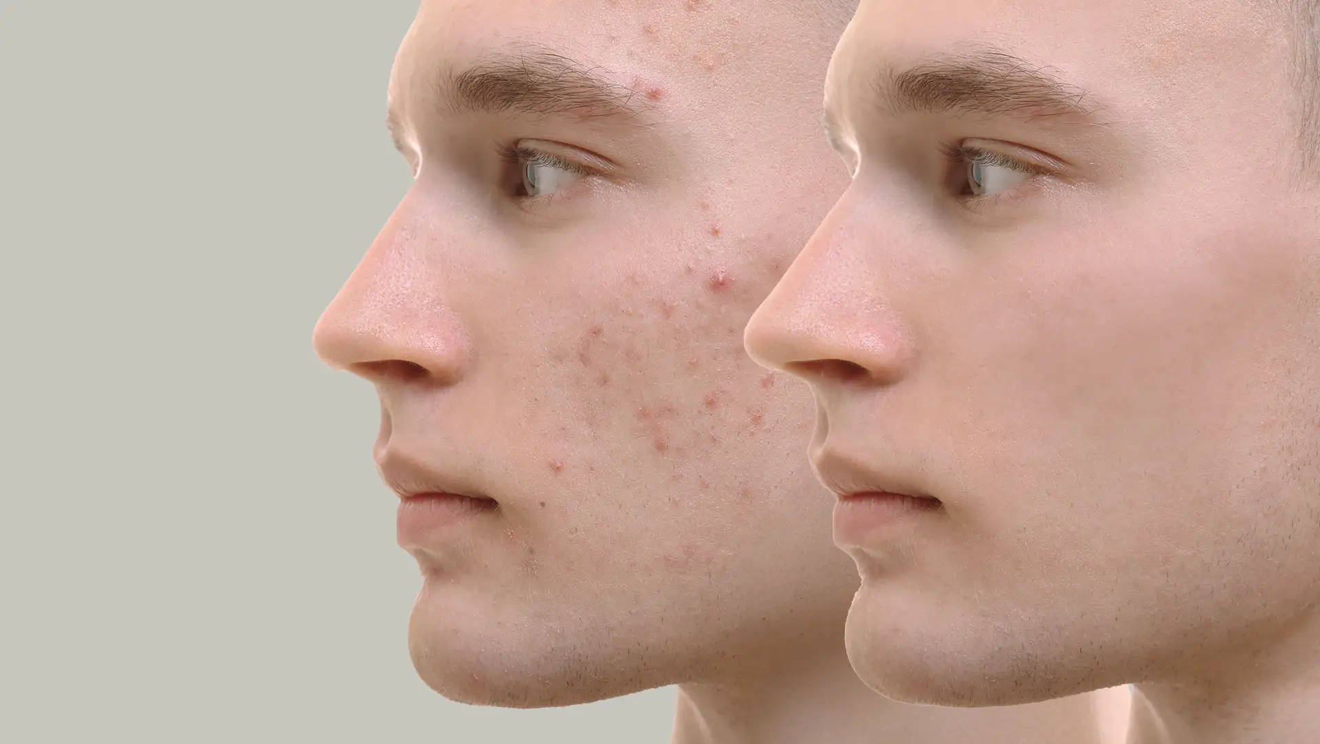 Acne scars removal