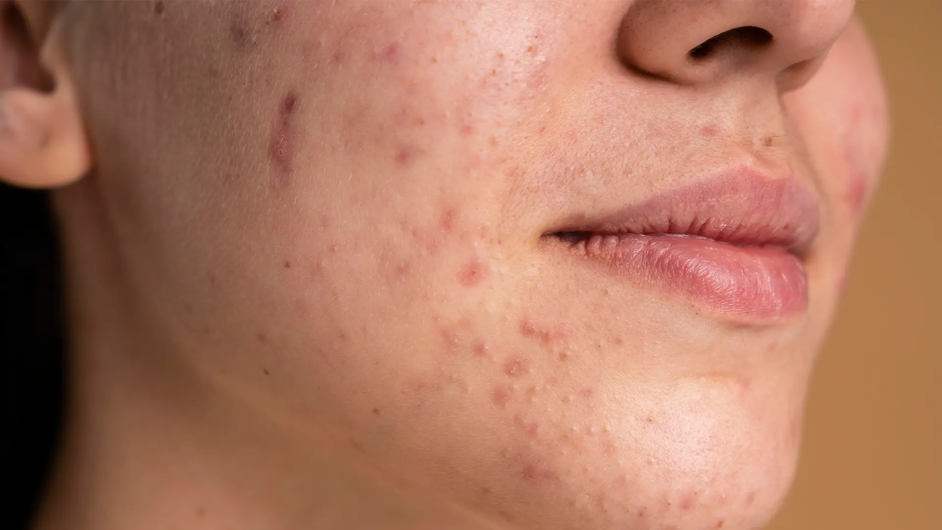 Acne scarring