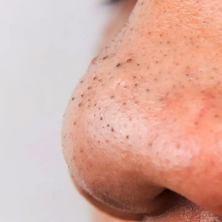 blackhead removal2