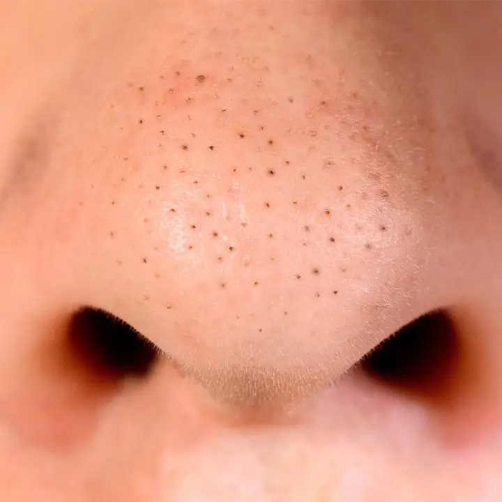 blackhead removal
