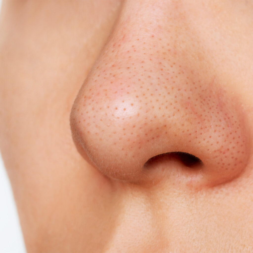 blackheads