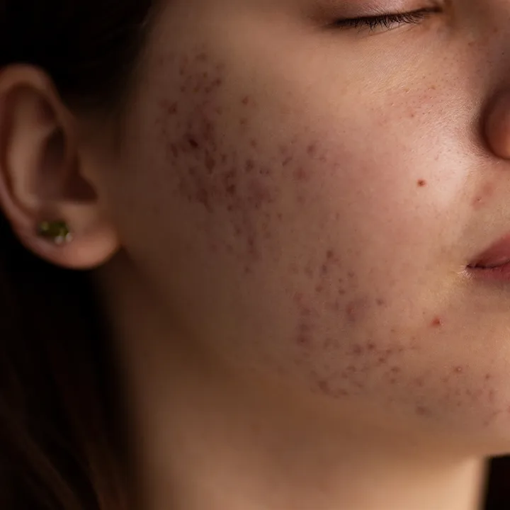 Congested skin