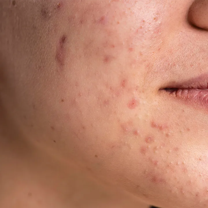 Congested skin
