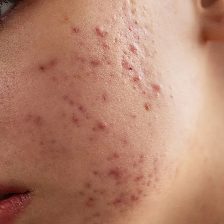 Congested skin