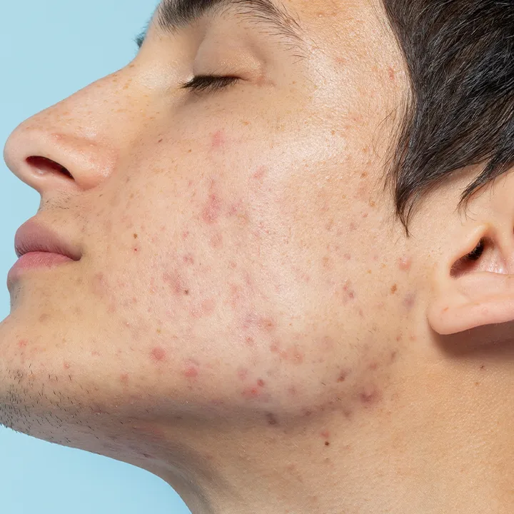 Congested skin