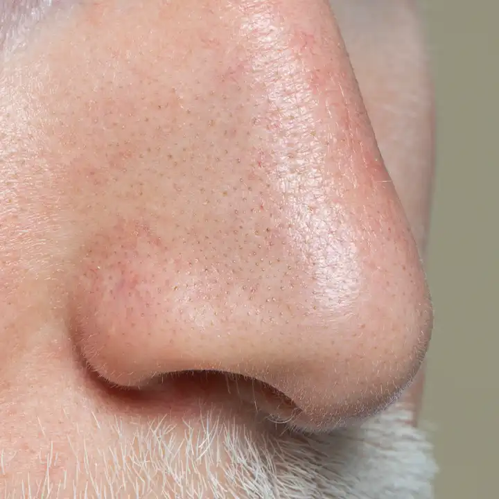 sebaceous filaments