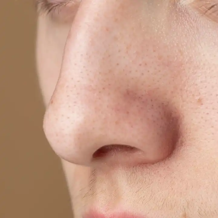 sebaceous filaments