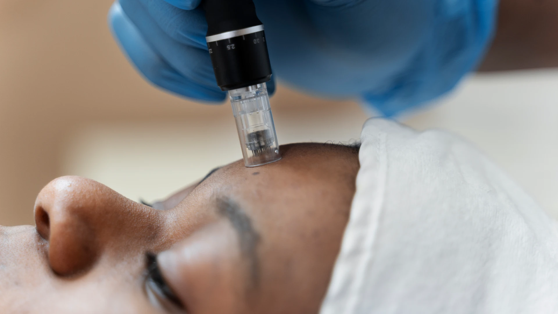 microneedling for wrinkles