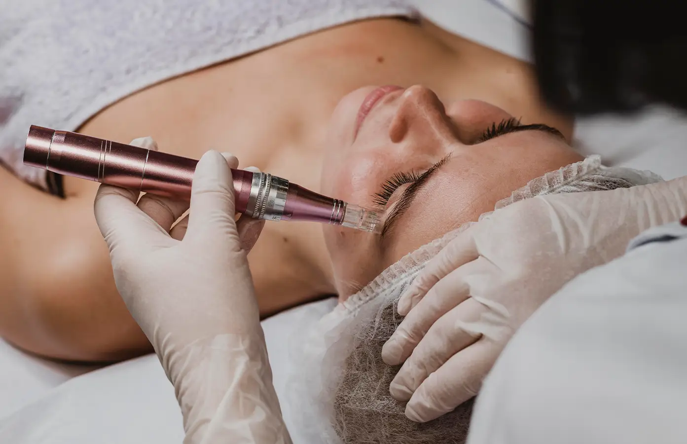 microneedling for wrinkles