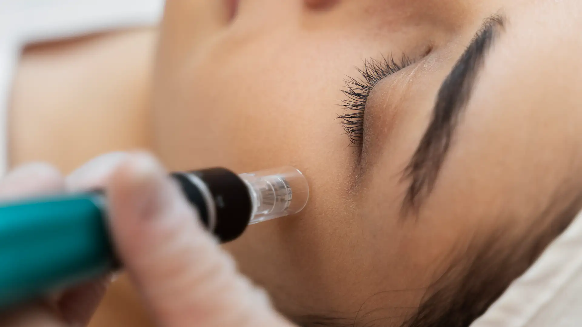 microneedling suitable skin