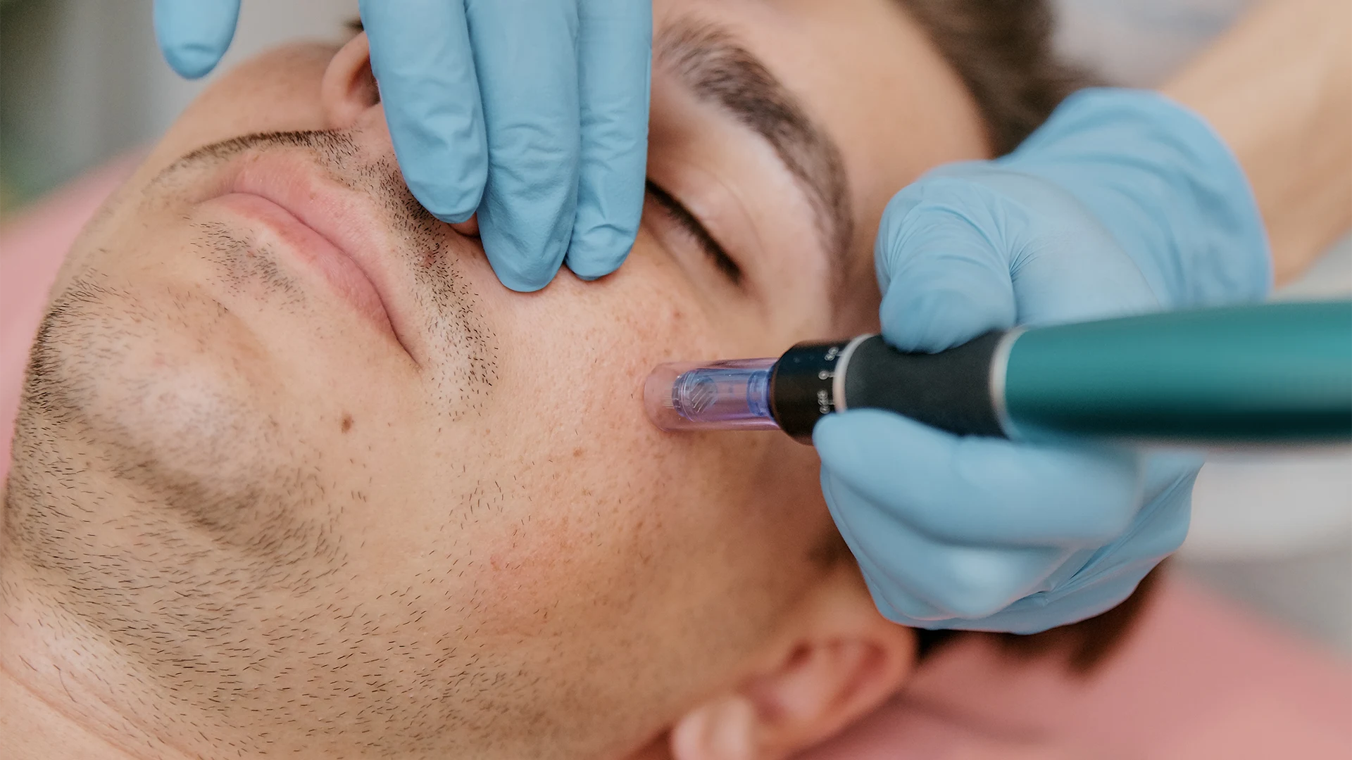 Microneedling